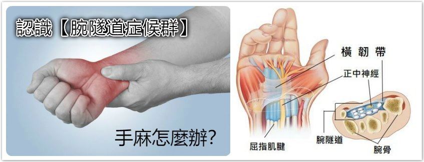 腕隧道症候群 